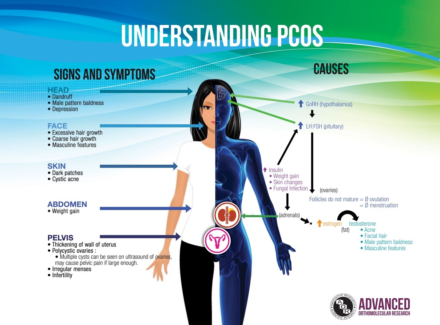 PCOS AND ENDOMETRIOSIS - Herbal treatment